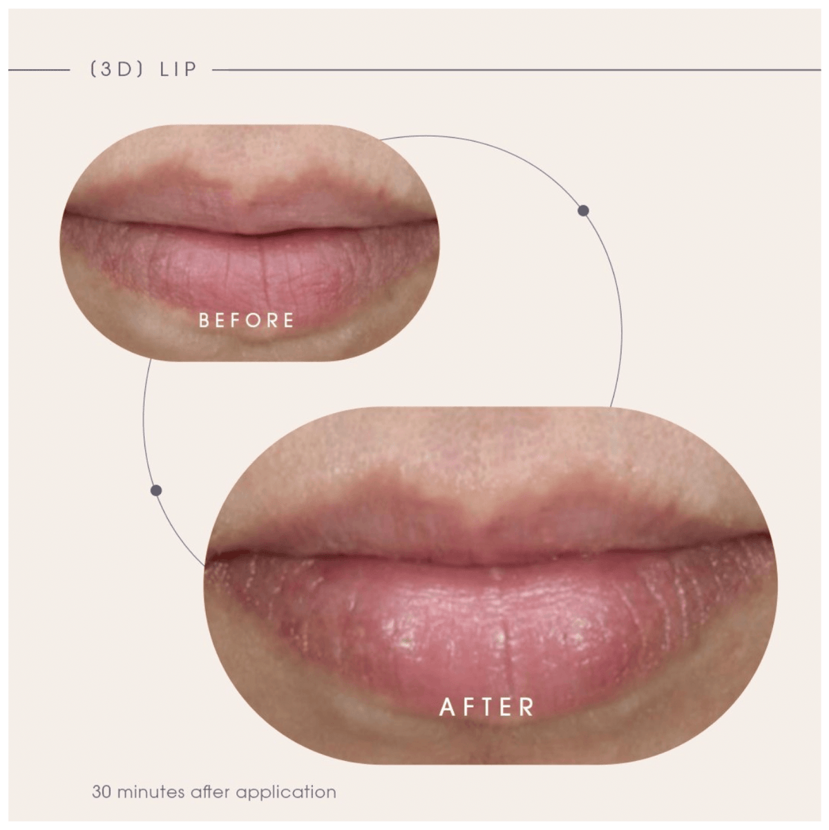 TEOXANE_3D_LipBeforeandAfter - PreLoved & Luxe
