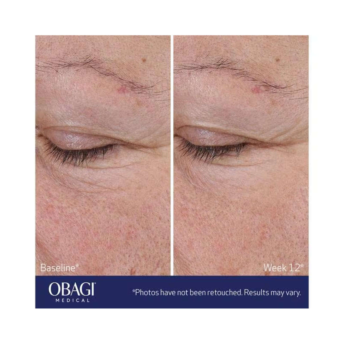 Obagi ELASTIderm® Advanced Filler Concentrate