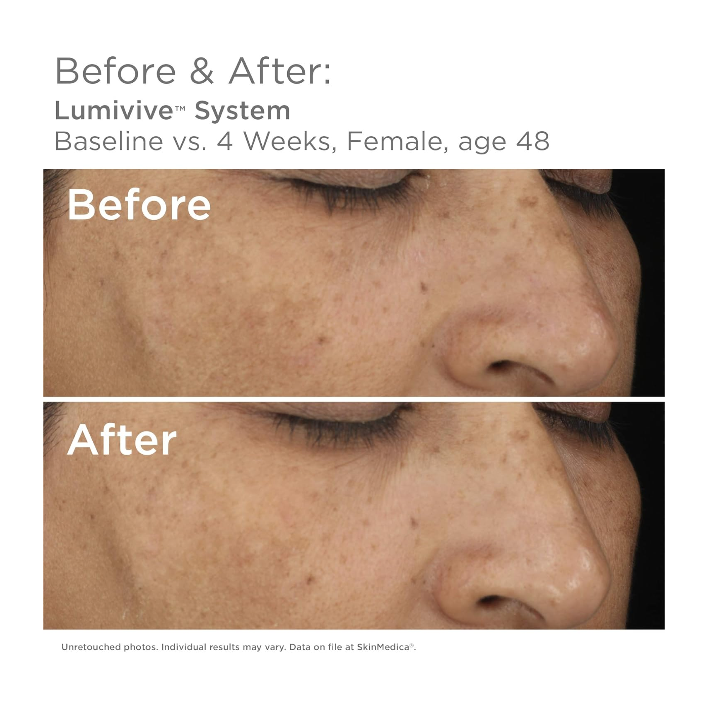 SkinMedica Lumivive™ System